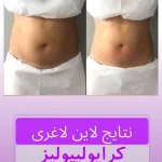 فیلر - 2